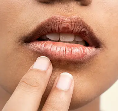 Uneven lip tone or dull appearance