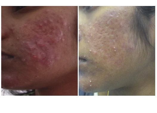Before & After Acne Treatment Results