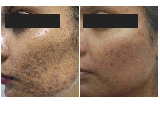 Before & After Acne Treatment Results