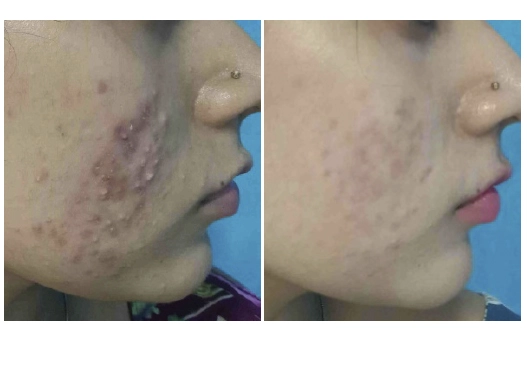 Before & After Acne Treatment Results