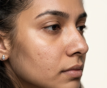 Blackheads