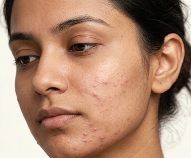 Papules