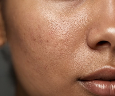 SaliPeel Treatment