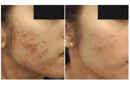 Before & After Acne Scar Treatment Results