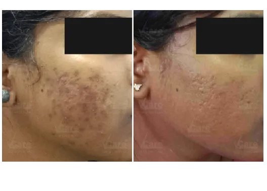 Before & After Acne Scar Treatment Results