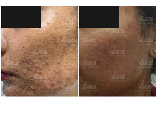Before & After Acne Scar Treatment Results