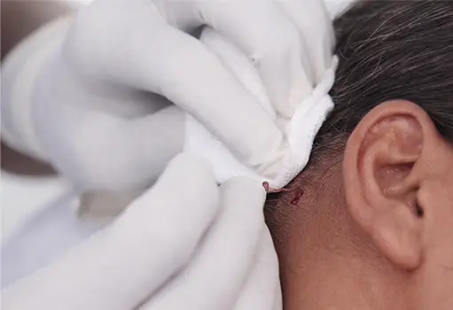 CellGraft skin Treatment