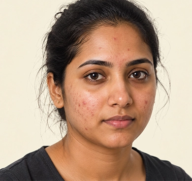 Adults with stress-related or mask-induced acne