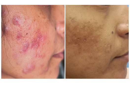 Before & After ACNEX Treatment Results
