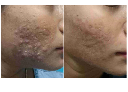 Before & After ACNEX Treatment Results
