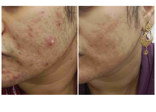 Before & After ACNEX Treatment Results