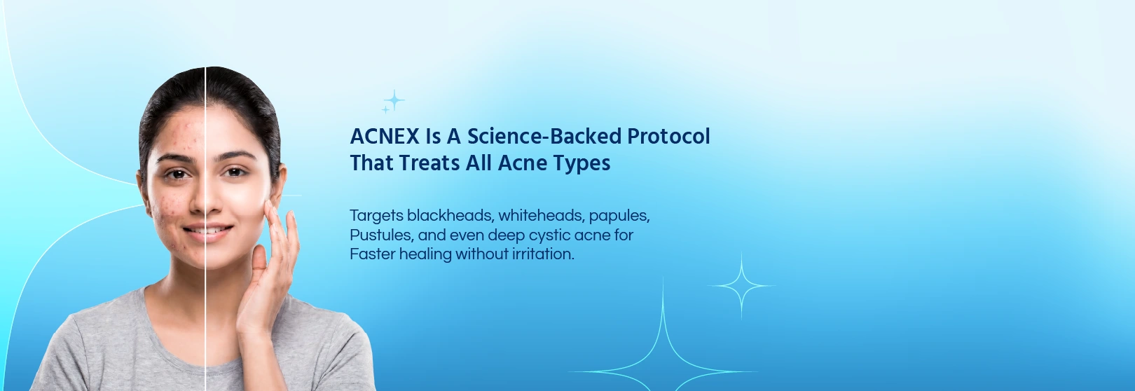 ACNEX Advanced Acne Treatment