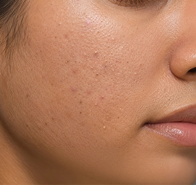 Those with whiteheads, blackheads, clogged pores & rough texture