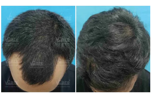 Before & After AFT 2.0 Hair Transplant Results