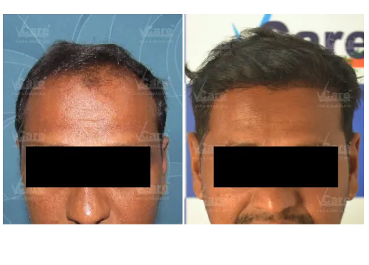 Before & After AFT 2.0 Hair Transplant Results