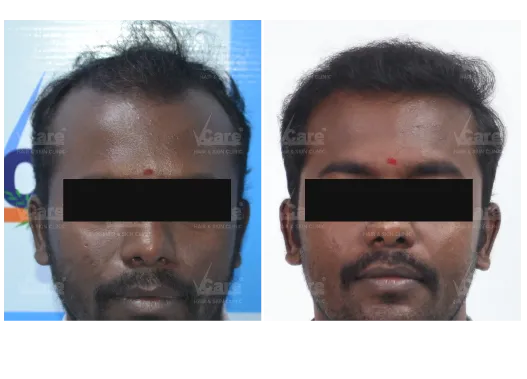 Before & After AFT 2.0 Hair Transplant Results