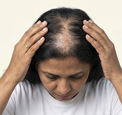 Those with genetic or pattern hair loss (androgenetic alopecia)