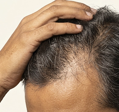 Individuals with weakened or dormant follicles