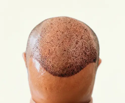 AFT 2.0 – Activated Follicular Transplantation