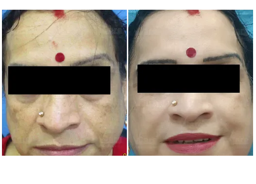 Before & After Anti-Aging Treatment Results