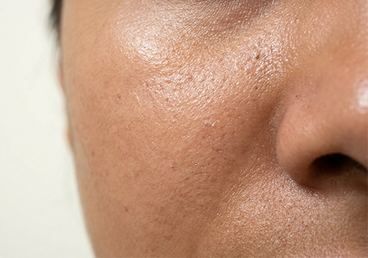 Sebum levels & pore condition