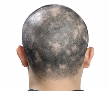 Telogen Effluvium