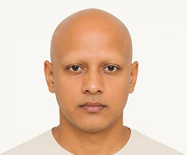 Alopecia Universalis