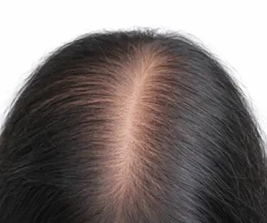 Diffuse Hair Loss