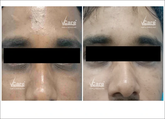 Before & After ArgiPeel Treatment Results