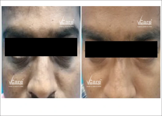 Before & After ArgiPeel Treatment Results