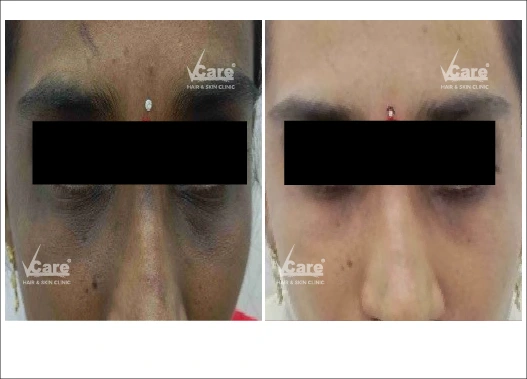 Before & After ArgiPeel Treatment Results
