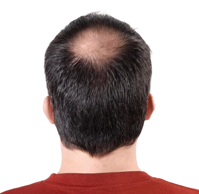 Baldness Treatment