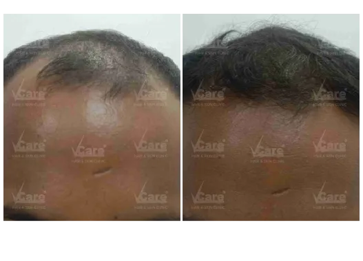 Before & After Baldness Treatment Results
