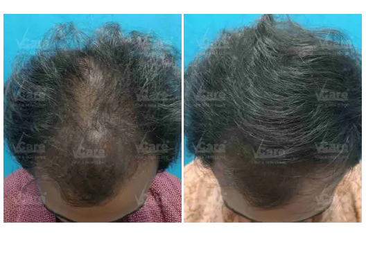 Before & After Baldness Treatment Results