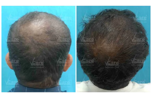 Before & After Baldness Treatment Results