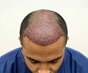 Hair Transplantation