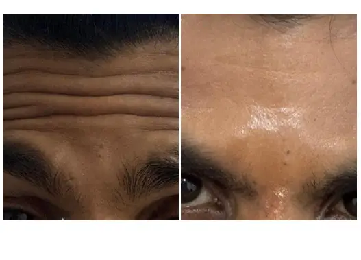 Before & After Botox Skin Treatment Results