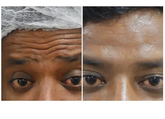 Before & After Botox Skin Treatment Results