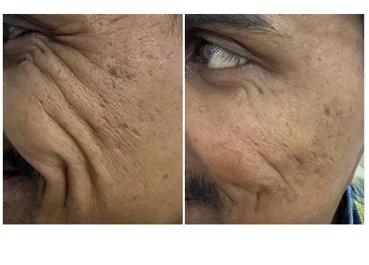 Before & After Botox Skin Treatment Results