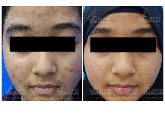 Before & After Carbon Laser Peel Treatment Results