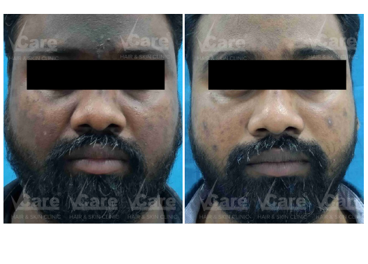Before & After Carbon Laser Peel Treatment Results