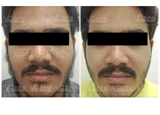 Before & After Carbon Laser Peel Treatment Results