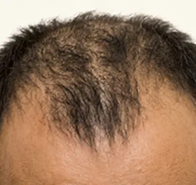 Those with androgenetic alopecia or post-transplant thinning