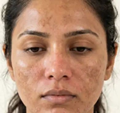 Those recovering from post-laser or post-peel skin damage