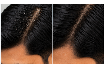 Before & After Dandruff Treatment Results