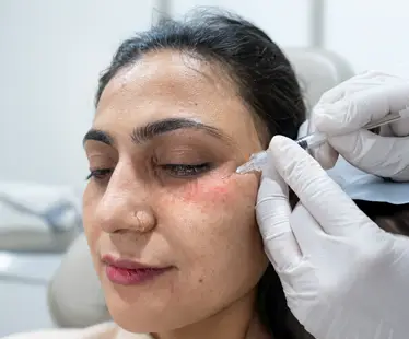 Dermal Fillers