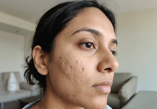 Depressed Marks