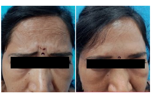 Before & After Dermal Fillers Treatment Results