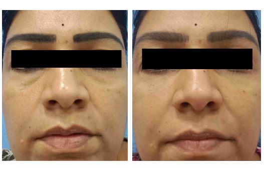Before & After Dermal Fillers Treatment Results