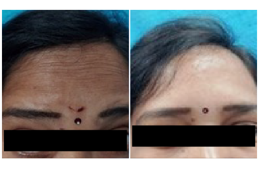 Before & After Dermal Fillers Treatment Results